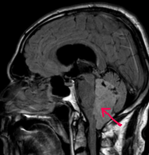 ملف:Ependymom sag FLAIRp.jpg