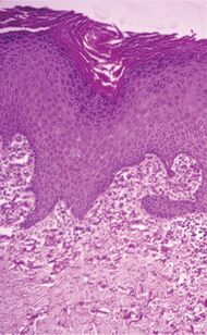 Histopathology of perforating calcific elastosis.jpg