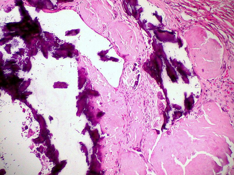 ملف:Amyloidosis, dystrophic calcification, H&E.jpg
