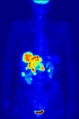 Maximum intensity projection (MIP) of a whole-body positron emission tomography (PET) acquisition of a 79 kg female after intravenous injection of 371 MBq of 18F-FDG (one hour prior measurement).