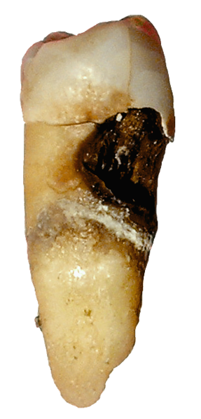 ملف:Toothdecay.png