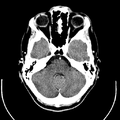 Computed tomography of brain of Mikael Häggström (7).png