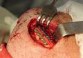 The surgical treatment of mandibular angle fracture.