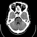 Computed tomography of brain of Mikael Häggström (8).png