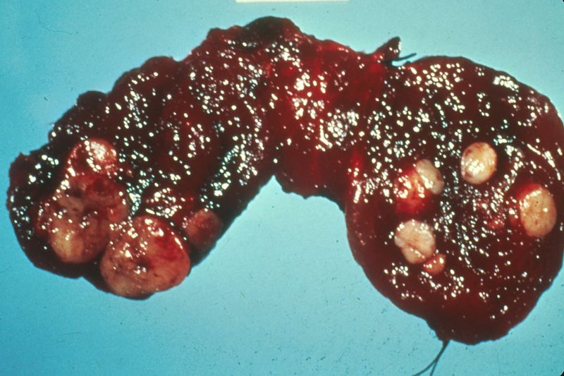 ملف:Human thyroid cancer.jpg