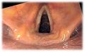 Endoscopic image of larynx seen at the time of intubation of the esophagus during gastroscopy.