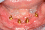 Ball overdenture