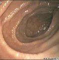 Endoscopic still of duodenum of patient with coeliac disease showing scalloping of folds.