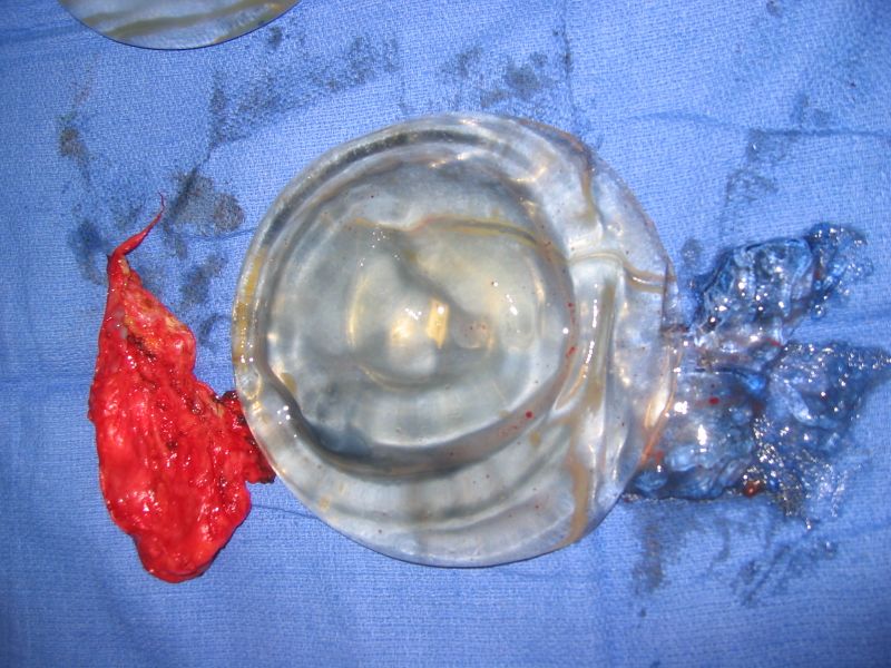 ملف:Ruptured implant.JPG
