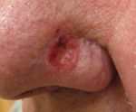 Basal cell carcinoma3.JPG