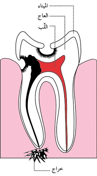 ملف:شكل3 نخر الأسنان.jpg