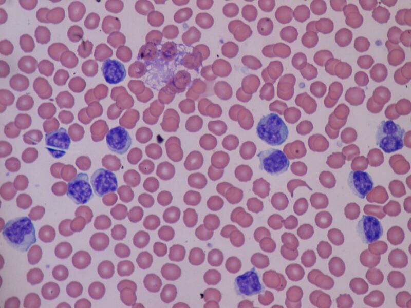 ملف:Lymphocytosis.JPG