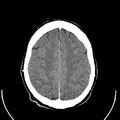 Computed tomography of brain of Mikael Häggström (23).png