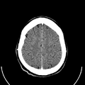 Computed tomography of brain of Mikael Häggström (25).png