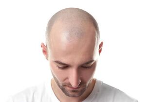 Baldness man.jpg
