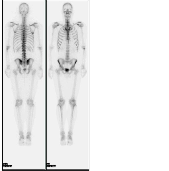 ملف:Nl bone scan2.jpg