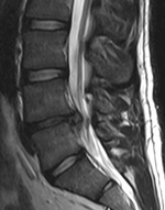 The straight leg raise test can detect pain originating from a herniated disc. When warranted, imaging such as MRI can provide clear detail about disc related causes of back pain (L4–L5 disc herniation shown)