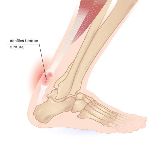ملف:Achilles tendon rupture.svg