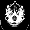 Computed tomography of brain of Mikael Häggström (2).png
