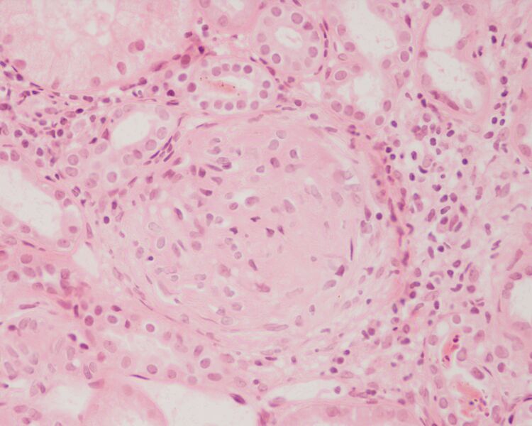 ملف:Crescentic glomerulonephritis HE stain.JPEG