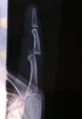 X-ray of left index finger dislocation