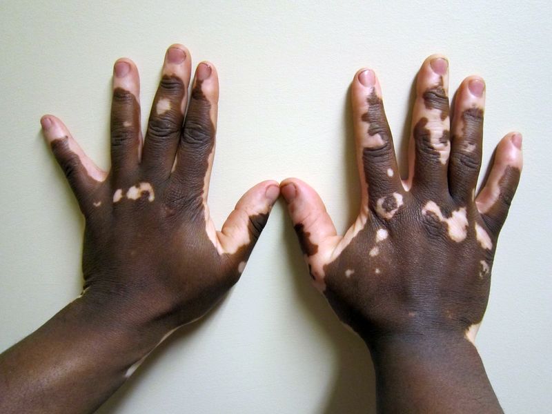 ملف:Vitiligo2.JPG