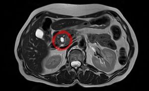 IPMN T2w ax-07 a.jpg