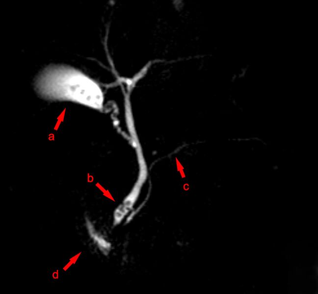 ملف:MRCP Choledocholithiasis.jpg