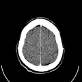 Computed tomography of brain of Mikael Häggström (26).png