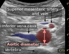 Compression is used in this ultrasonograph to get closer to the abdominal aorta, making the superior mesenteric vein and the inferior vena cava look rather flat.