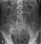An x-ray of a person with a small bowel volvulus.