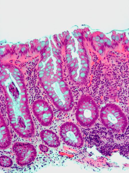 ملف:Hyperplastic polyp1.jpg