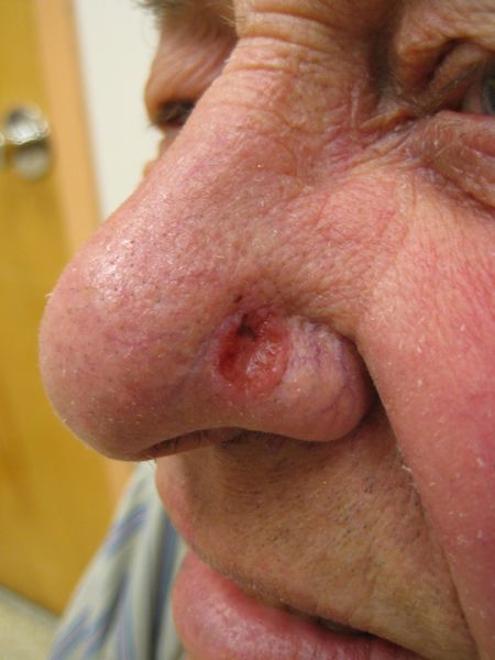ملف:Basal cell carcinoma2.JPG