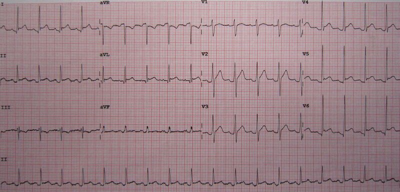 ملف:Pericarditis10.JPG