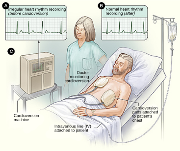 ملف:Cardioversion.svg