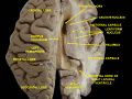 Ventricles of brain and basal ganglia.Superior view. Horizontal section.Deep dissection