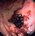 Gastric ulcer in antrum of stomach with overlying clot due to gastric lymphoma.
