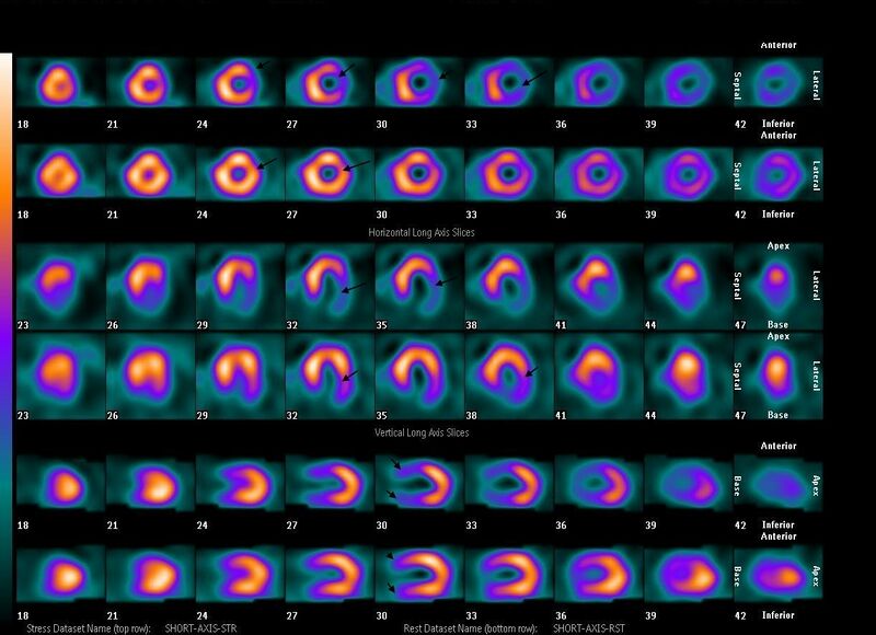 ملف:Isquemia lateral.jpg