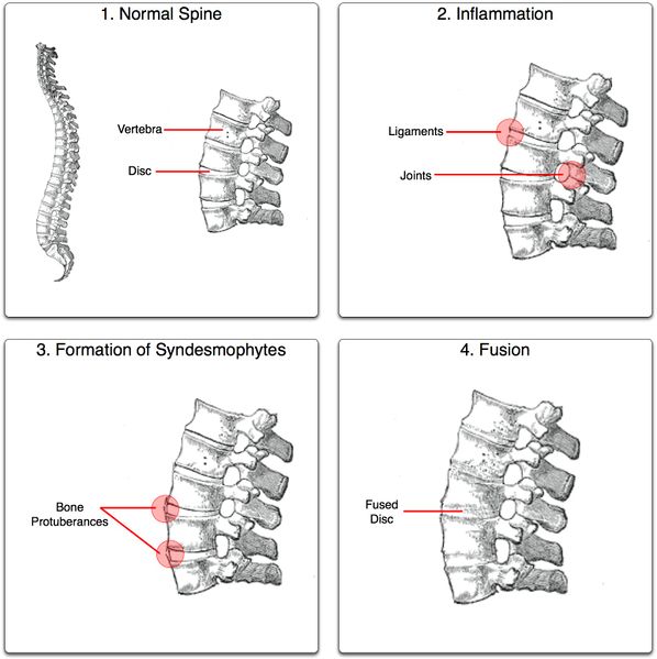 ملف:Ankylosing process.jpg