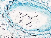 Angio invasive pulmonary aspergillosis