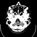 Computed tomography of brain of Mikael Häggström (3).png