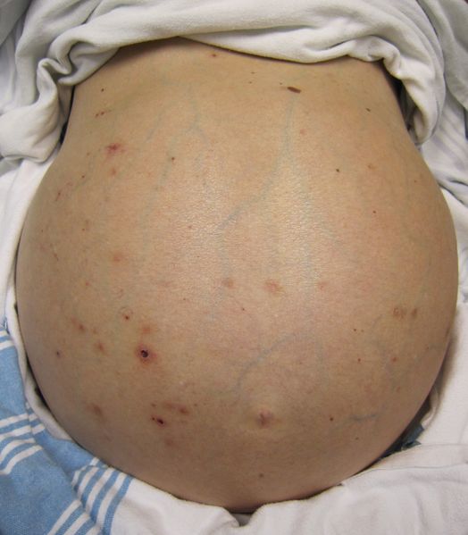 ملف:Hepaticfailure.jpg