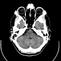 Computed tomography of brain of Mikael Häggström (6).png