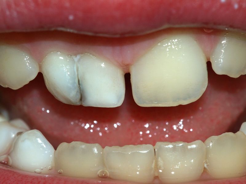 ملف:Milk.teeth.fusion.jpg