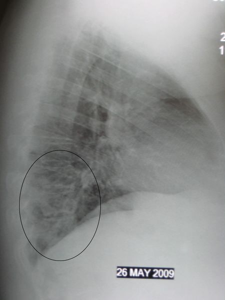 ملف:RLL pneumoniaLM.jpg