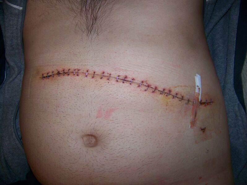 ملف:Splenectomy-scar.jpg