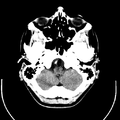 Computed tomography of brain of Mikael Häggström (4).png