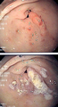 Endoscopic image of gastric antral vascular ectasia seen as a radial pattern around the pylorus before (top) and after (bottom) treatment with argon plasma coagulation