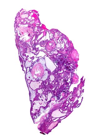 Adamantinomatous craniopharyngioma - very low mag.jpg