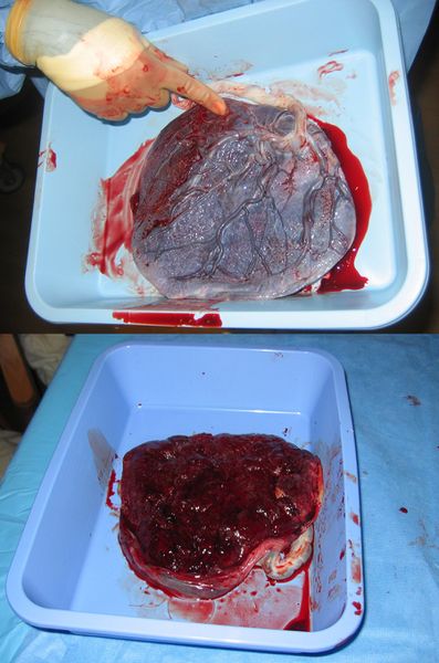 ملف:Human placenta both sides.jpg